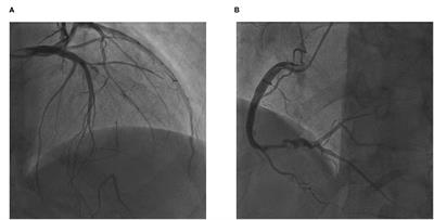 Transradial Retrograde Percutaneous Coronary Intervention of Chronic Total Occlusion via an Ipsilateral Septal Collateral Using a Single Guiding Catheter: A Case Report